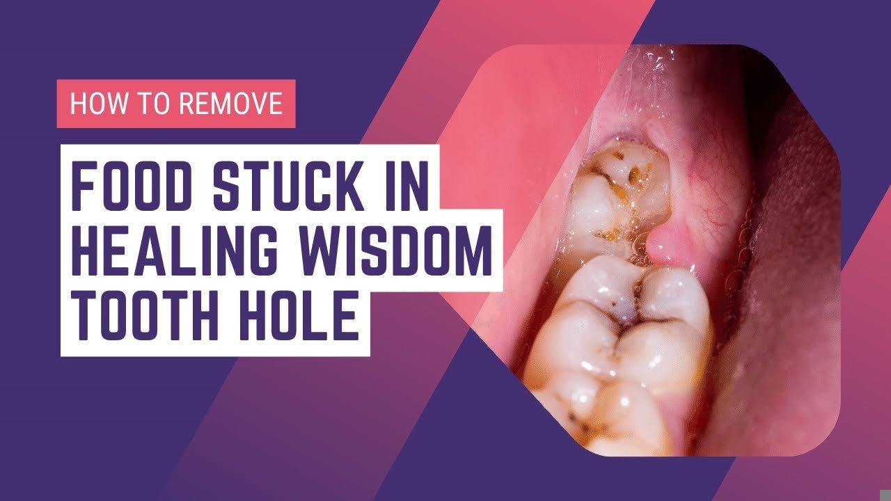 How To Remove Food Stuck In Wisdom Tooth Hole Safely